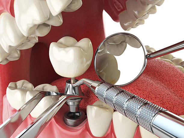 Best Knocked-Out Tooth (Avulsed Tooth) Treatment in Decorah, IA